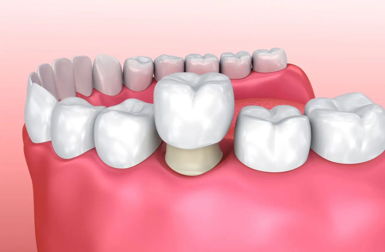 Zirconium Crown
